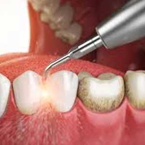 close-up of teeth being cleaned with a dental pick