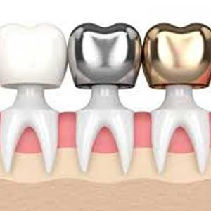 Various types of dental crowns