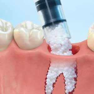 Bone grafting