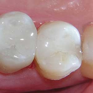 Composite fillings