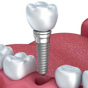 Single tooth dental implant