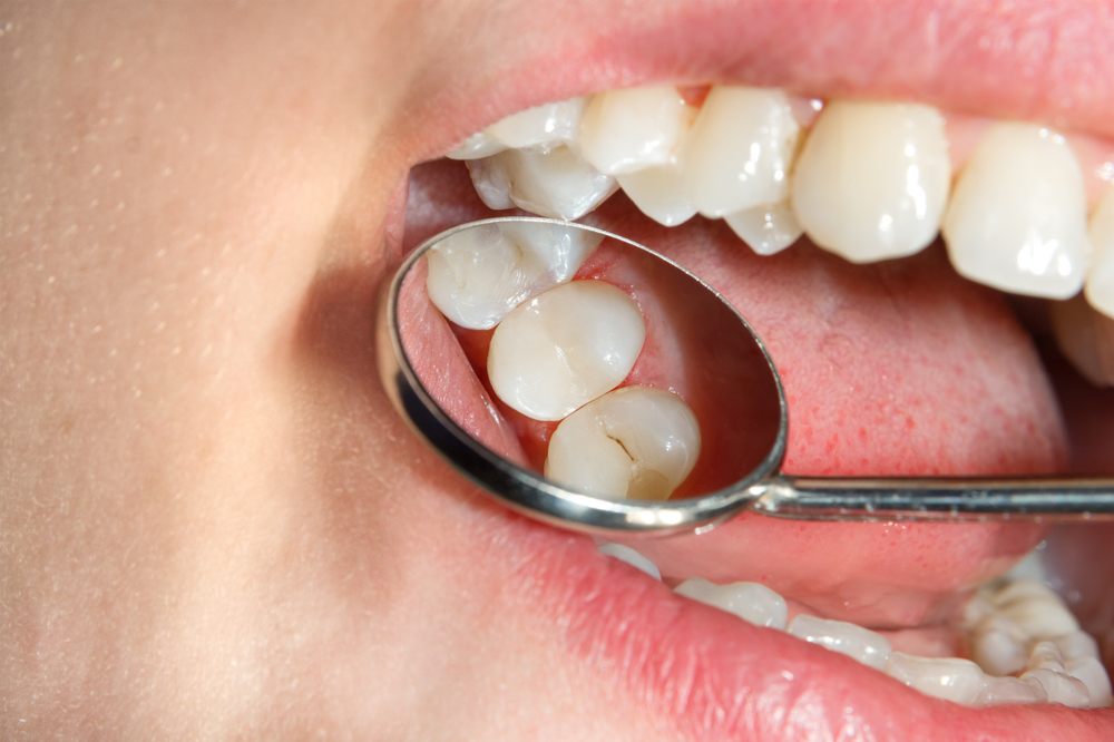 teeth being examined with dental mirror